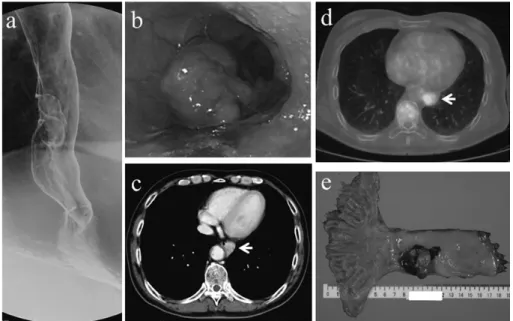 Fig. 3 （Case 2）　a : Barium esophagogram demonstrating an irregular polypoid tumor in the 