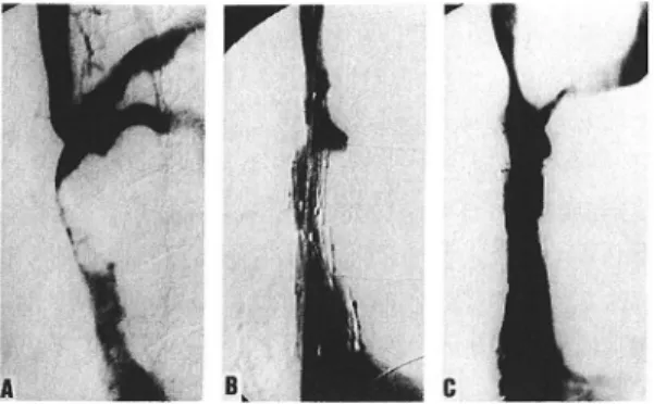 Fig.  4  Case  2.  (A)  Cavogram  revealed  severe stenosis  of  the  SVC  with  collaterals