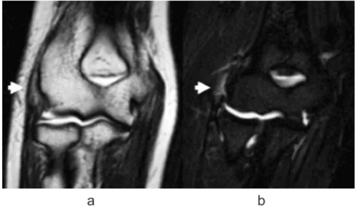 図 1　術前単純 MRI 検査 　　　a. T2 強調画像（T2），b.T2 強調脂肪抑制画像        （ T2FS）にて ECRB 腱起始部の高信号領域（白       矢印）を認める．　 と 1 年以上経過時に撮影し，T2 強調画像，T2 強調脂肪抑制画像で評価した．臨床成績は術前後のJOA-JES score と仕事やスポーツへの復帰状況を調査した．　肘関節造影検査；注入は刺入部より逆流する造影剤の影響を小さくするため， X 線透視下に内側穿刺により行った．カテラン針を用いて腕尺関節面を狙い，6
