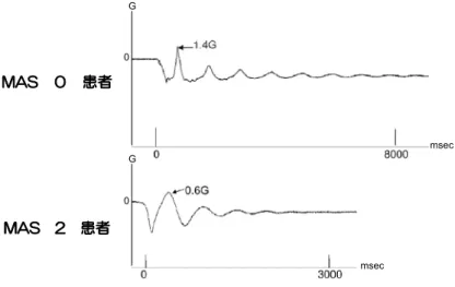 図 4  Pendulum Test 時の Modified Ashworth Scale が 0 と 2 の患者の Y 軸 （下腿下垂位の下腿軸に直交する前後方向）加速度の生波形の例   上図は、 Pendulum Test の加速度生波形である。Modified Ashworth Scale 0 の患者群は 落下後 8 回程度の振れと衝撃を示しているのに対して、Modified Ashworth Scale 2 の生 波形では 3 回程度の振れで振動が停止した。  Ⅴ．筋硬度値と Brunnstrom 