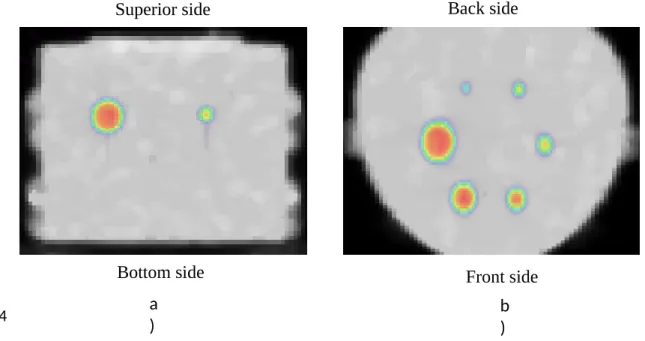 Fig. 4 Super imposed images of transmission and emission scans. The PET images; a) coronal   image   where   two   spots   indicate   the   37   mm   and   17   mm   spheres,   and   b) transaxial image where six spots indicate the six spheres of the NEMA 