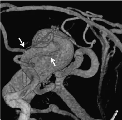 Fig. 4   Left  vertebral  artery  angiogram  (A)  and  the  left  internal  carotid  angiogram  (B)  (anterior-posterior  views)  showing shunt flow through the posterior communicating artery and the anterior communicating artery.