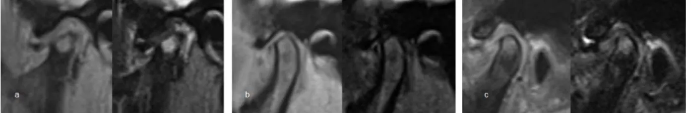 図 3.  下顎頭骨髄信号異常の分類（左：プロトン密度強調画像；右：T2 強調画