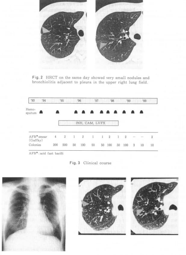 Fig.  2  HRCT  on  the  same  day  showed  very  small  nodules  and  bronchiolitis  adjacent  to  pleura  in  the  upper  right  lung  field .