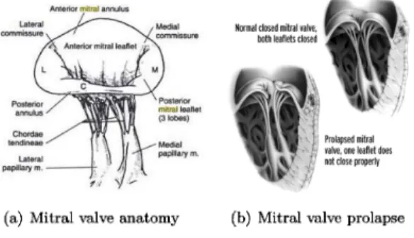 Figure 10: (a) Anatomy of the mitral valve [16] and (b) comparison between a normal mitral valve and a prolapsed mitral valve.