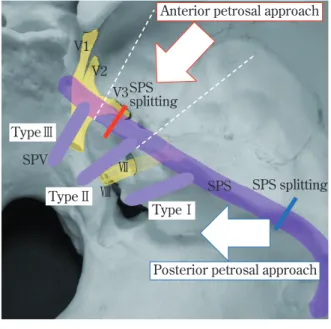 Fig.   8  Three patterns of the SPVC drainage  and the splitting point of the SPS in  a n t e r i o r  a n d  p o s t e r i o r  p e t ro s a l  approaches