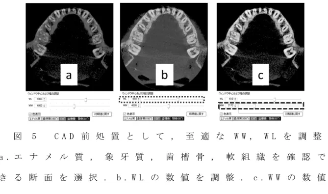 図 5   C A D 前 処 置 と し て ， 至 適 な W W ， W L を 調 整   a . エ ナ メ ル 質 ， 象 牙 質 ， 歯 槽 骨 ， 軟 組 織 を 確 認 で き る 断 面 を 選 択 ． b 