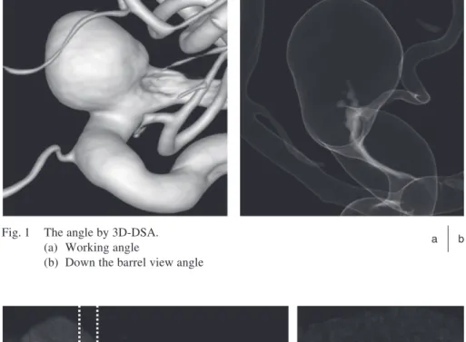 Fig. 1  The angle by 3D-DSA. (a)  Working angle
