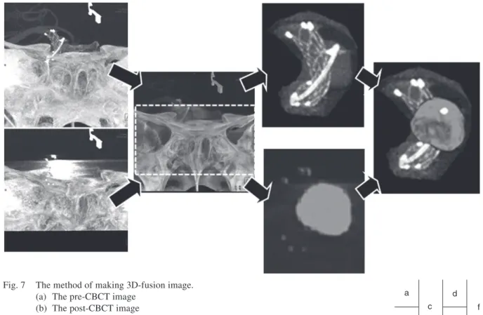 Fig. 7  The method of making 3D-fusion image. (a)  The pre-CBCT image