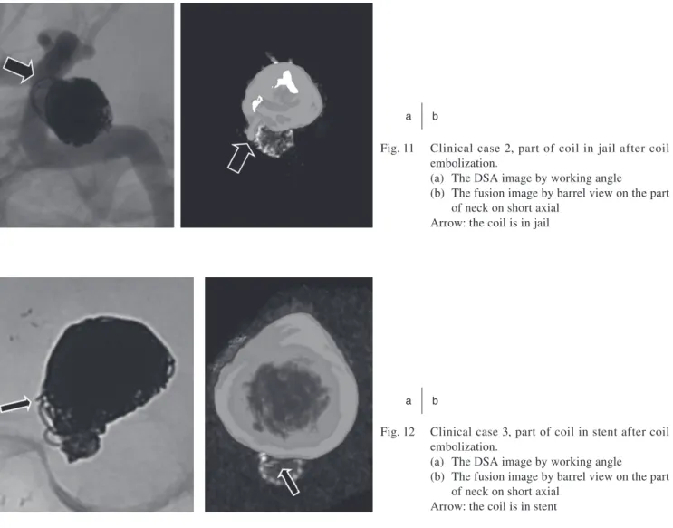 Fig. 11  Clinical case 2, part of coil in jail after coil  embolization.