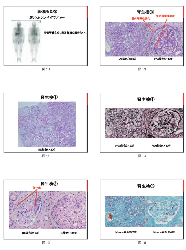 図 15 腎生検⑤Masson染色(×200) Masson染色(×400)図 14腎生検④PAM染色(×200)PAM染色(×400)図 13腎生検③PAS染色(×200)PAS染色(×400)管内増殖性変化管外増殖性変化腎生検②HE染色(×400)HE染色(×400)好中球図 12腎生検①HE染色(×200)図 11画像所見③ガリウムシンチグラフィー・両側腎臓含め、異常集積は認めない。図 10