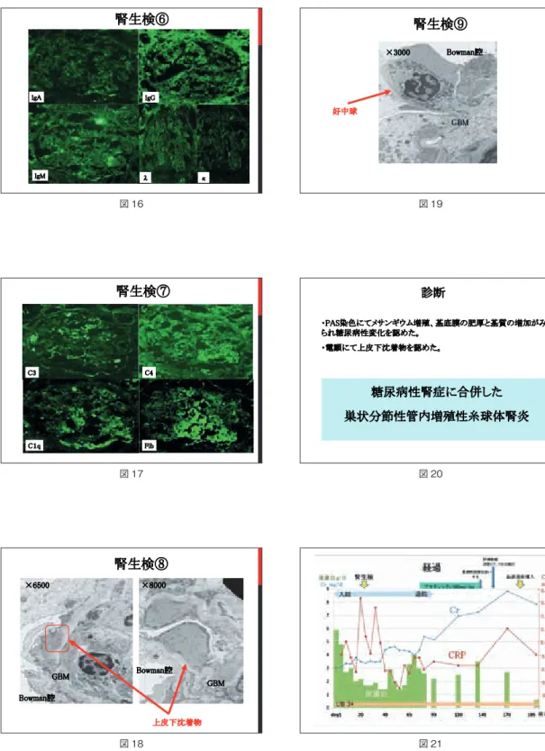 図 21図 20 診断 糖尿病性腎症に合併した 巣状分節性管内増殖性糸球体腎炎 ・PAS染色にてメサンギウム増殖、基底膜の肥厚と基質の増加がみられ糖尿病性変化を認めた。・電顕にて上皮下沈着物を認めた。図 19腎生検⑨×3000Bowman腔好中球腎生検⑧×6500×8000GBMGBMBowman腔上皮下沈着物Bowman腔図 18腎生検⑦C3C4C１qFib図 17腎生検⑥IgAIgGIgMλκ図 16
