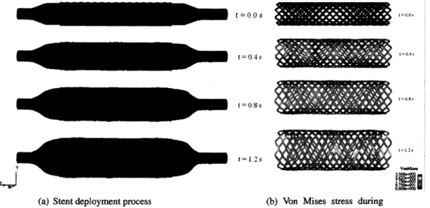 Figure 4: Stent deployment