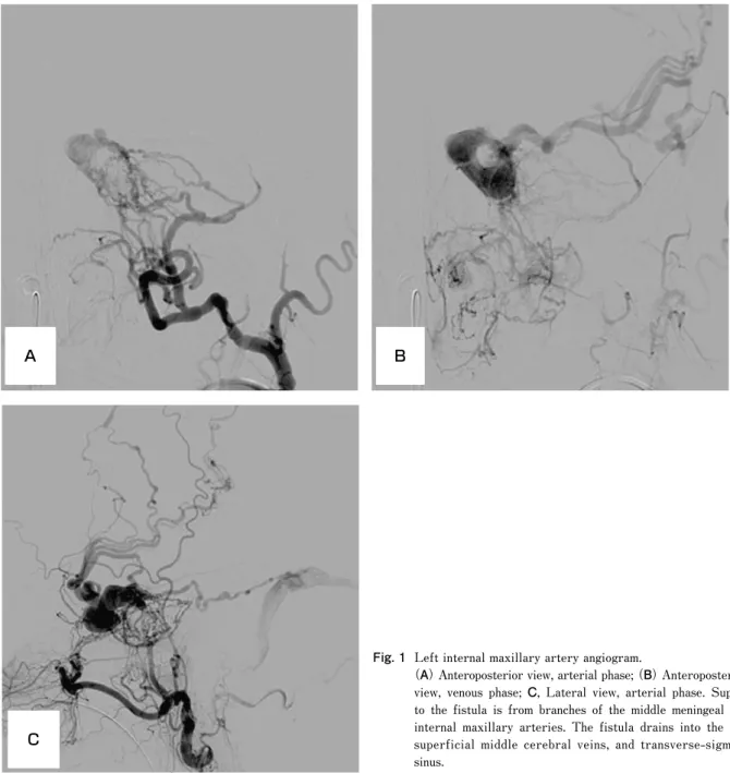 Fig. 1   Left internal maxillary artery angiogram.
