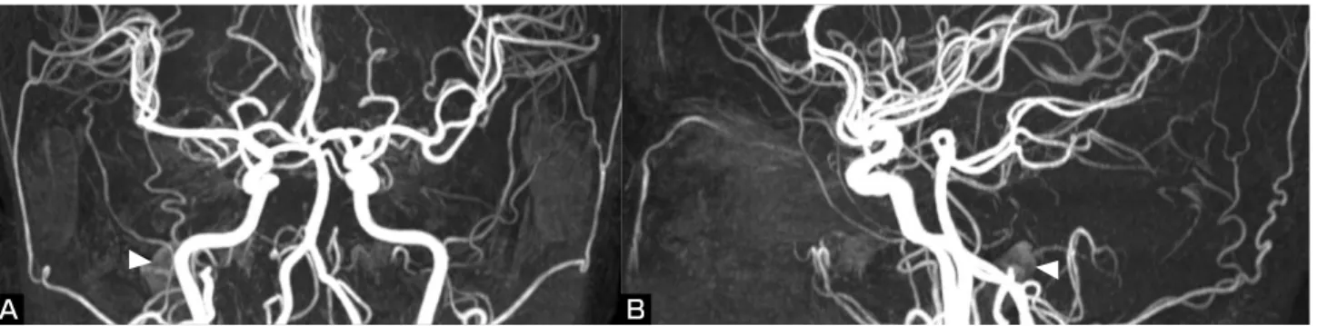 Fig. 2   Axial (A, B, C) and sagittal views (D) of contrast-enhanced CT scan demonstrating an enlarged high jugular bulb on  the right side (asterisks)