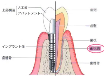 図 1 Structure of a dental implant and a natural tooth インプラントと天然歯の構造