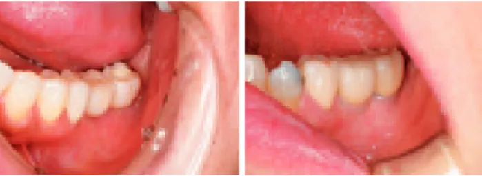 図 3 Intra  oral  views  after  the  implant  prosthesis  was  placed, that mesiodistal crown diameter was  short-ened
