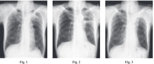 Fig. 1 Chest X-ray showed an abnormal shadow at the left apex just adjacent to a bulla