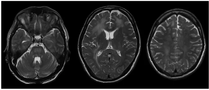 Fig. 1　Brain MRI T 2  weighted images.