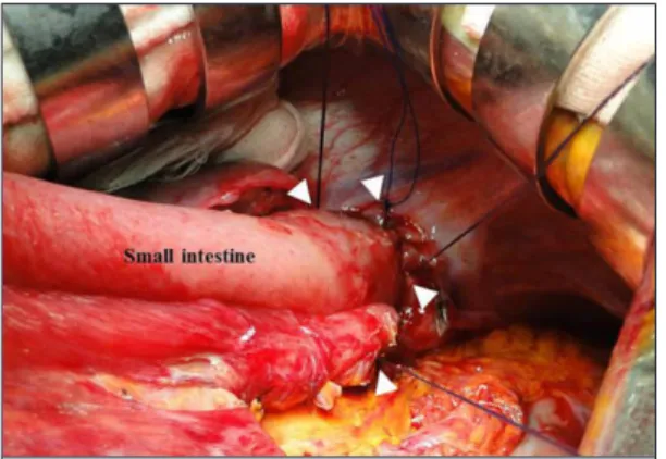 Table 1 Reported case of esophageal hiatus hernia after total gastrectomy