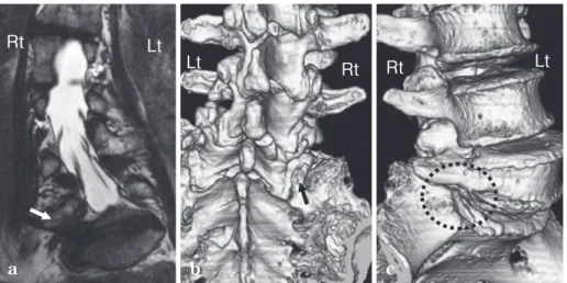 Fig.  1 78−year−old woman who presented with severe right leg pain（Case 4）  a ：Coronal CISS MR image showing lumbar scoliosis（Cobb angle 34.2° ；right convex；L5 