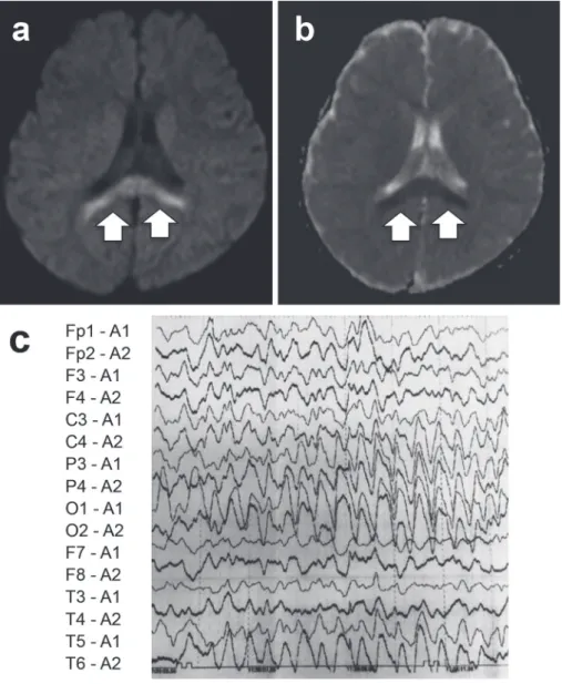 図 1 　第 3 病日の頭部 MRI の拡散強調画像（a）と apparent diffusion coefﬁcient（ADC）map（b）