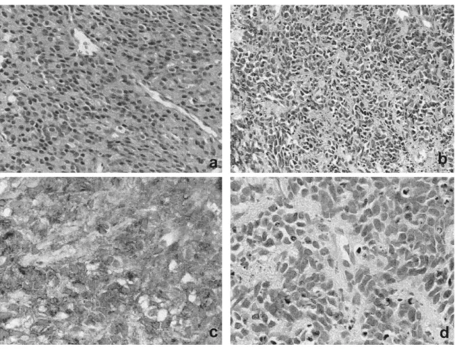 Fig. 1. Microscopic ﬁndings of an initial biopsy specimen showed poorly differentiated adenocarcinoma, Gleason