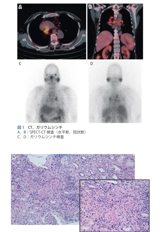 図 1　 CT，ガリウムシンチ A，B：SPECT-CT 検査（水平断，冠状断） C，D：ガリウムシンチ検査AC B D 図 2　 腎生検所見 A：HE 染色　弱拡大 B：HE 染色　強拡大A B