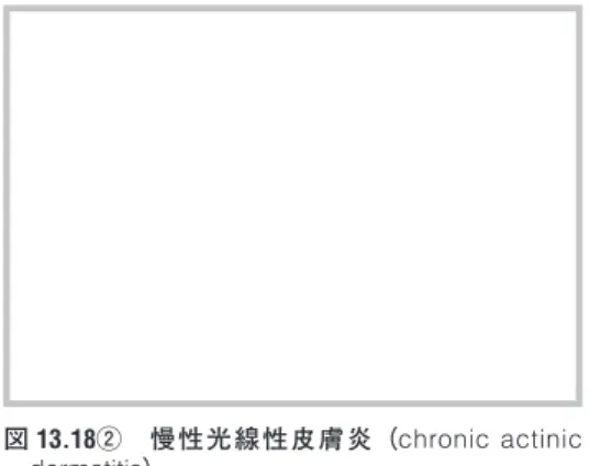図 13.18②　慢性光線性皮膚炎（chronic actinic 