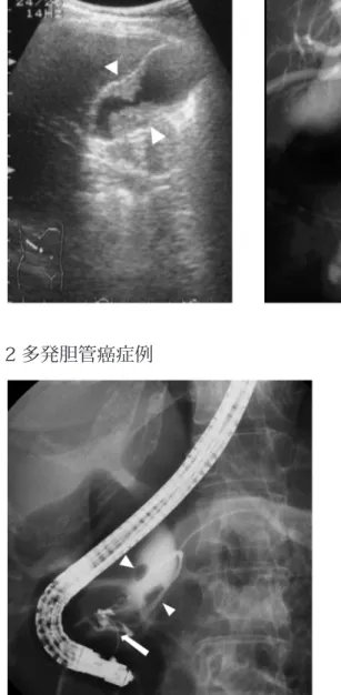 Fig. 3 膵・胆管合流異常合併有無別胆道癌術後生存率