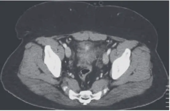 Fig. 1　Image  of  inflammation  at  the  urinary  bladder apex; notable subcutaneous fat
