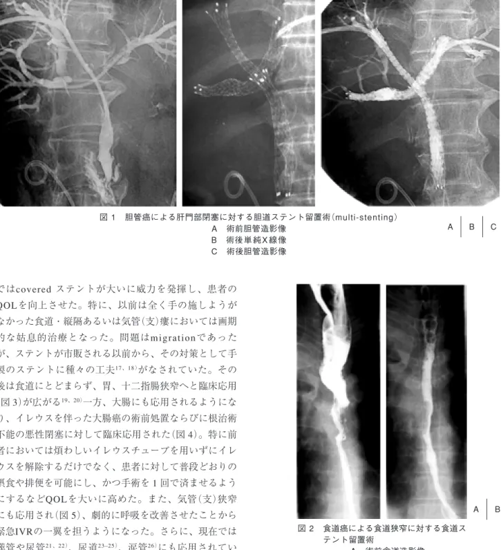図 1 胆管癌による肝門部閉塞に対する胆道ステント留置術（multi-stenting） A 術前胆管造影像 B 術後 単 純 X 線 像 C 術後胆管造影像 A      B      C 図 2 食道癌による食道狭窄に対する食道ス テント留置術 A 術前食道造影像 B 術後食道造影像 A      Bではcovered  ステントが大いに威力を発揮し、患者のQOLを向上させた。特に、以前は全く手の施しようがなかった食道・縦隔あるいは気管（支）瘻においては画期的な姑息的治療となった。問題はm i g r 