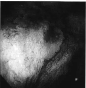 Figure  5.  The  biopsy  specimen  on  September  the  16th  1987  showing  the  histological  features  of  high-grade  dysplasia.