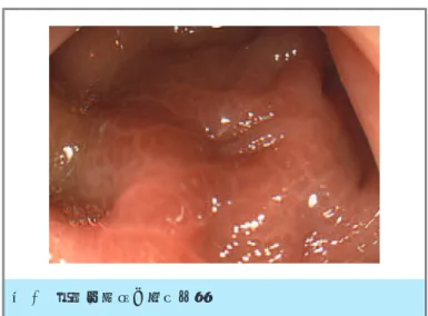 図 2 大腸黒皮症の内視鏡像