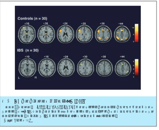 図 1 IBS の脳の機能的磁気共鳴画像（fMRI）