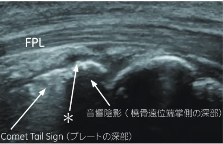 図 5.  橈骨遠位端掌側の長軸像      （プレート設置状態）