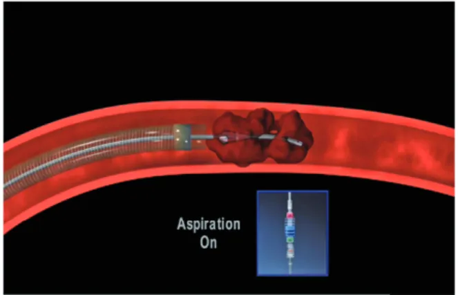 図 3 　A schematic drawing of stent retriever（Solitaire） 図 2 　A schematic drawing of Penumbra system