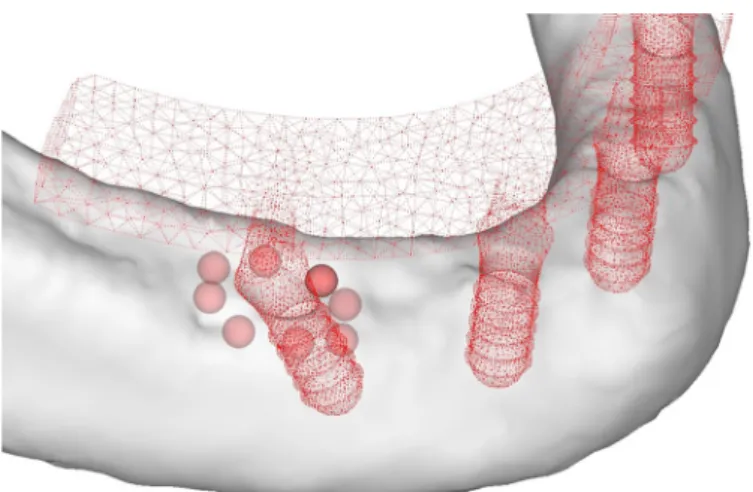 Fig. 3 – Measurement points for principal strains in bone around the implant.