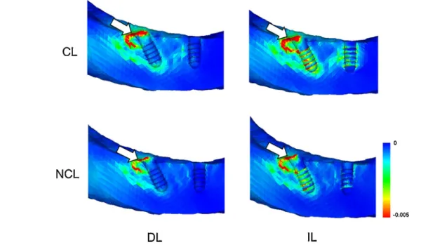 Fig. 7 – Distribution of principal tensile strain in the mesiodistal cross-sections (titanium framework model)
