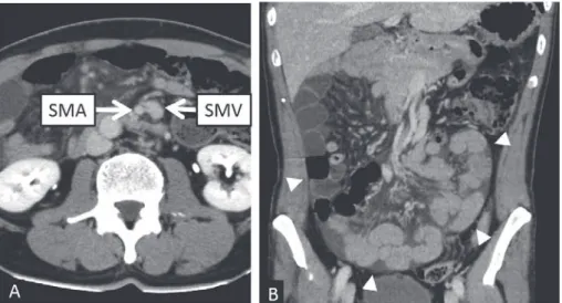 Fig. 2　Abdominal enhanced CT showed characteristic features of right paraduodenal  hernia and malrotation.