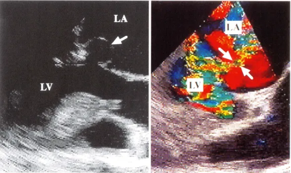 Fig.  2.  Transesophageal  echocardiogram. 