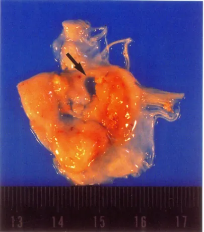 Fig.  3.  Surgical specimen  of  the  mitral valve. 