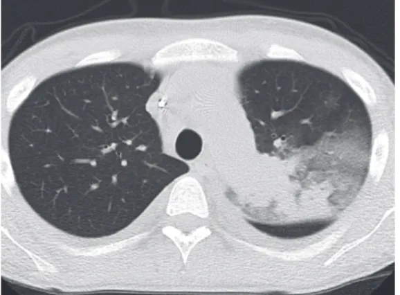Fig. 2. CT: Consolidation in the left upper lobe, ground glass  opacity(GGO) existed around that.