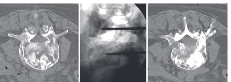 Table 1  Summary of meta-analysis of PVP for spinal  bone metastasis