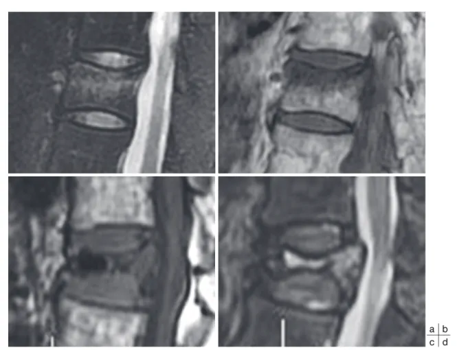 Table 2  Summary of meta-analysis of PVP for verte- verte-bral compression fracture due to osteoporosis