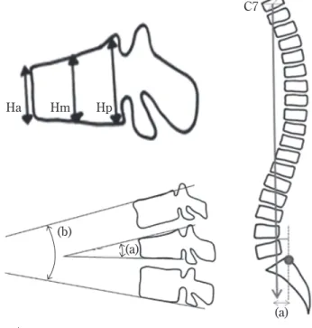 Fig.   1    A ：Schematic illustration of the  method for measuring vertebral body heights