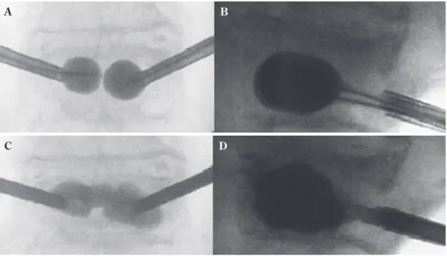 Fig.   2  Intraoperative fluoroscopic images（AP and lateral views）  A ：Balloon inflation, AP views