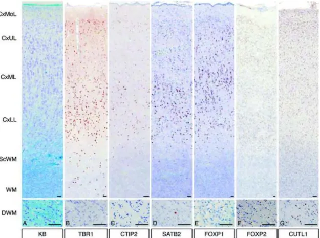 FIGURE 2. Expression patterns of layer-specific markers in focal cortical dysplasia  (FCD) IIA