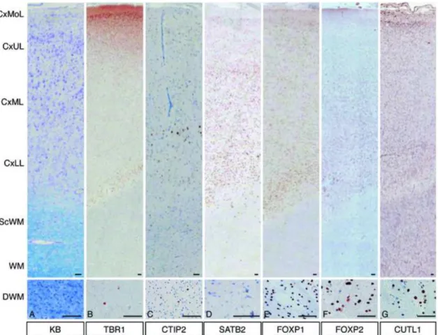 FIGURE 3. Expression patterns of layer-specific markers in focal cortical dysplasia  (FCD) IIB
