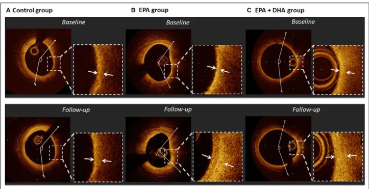 Figure 2.  Representative cases of optical coherence tomography analysis.